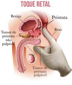 Câncer De Próstata