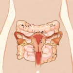 Endometriose