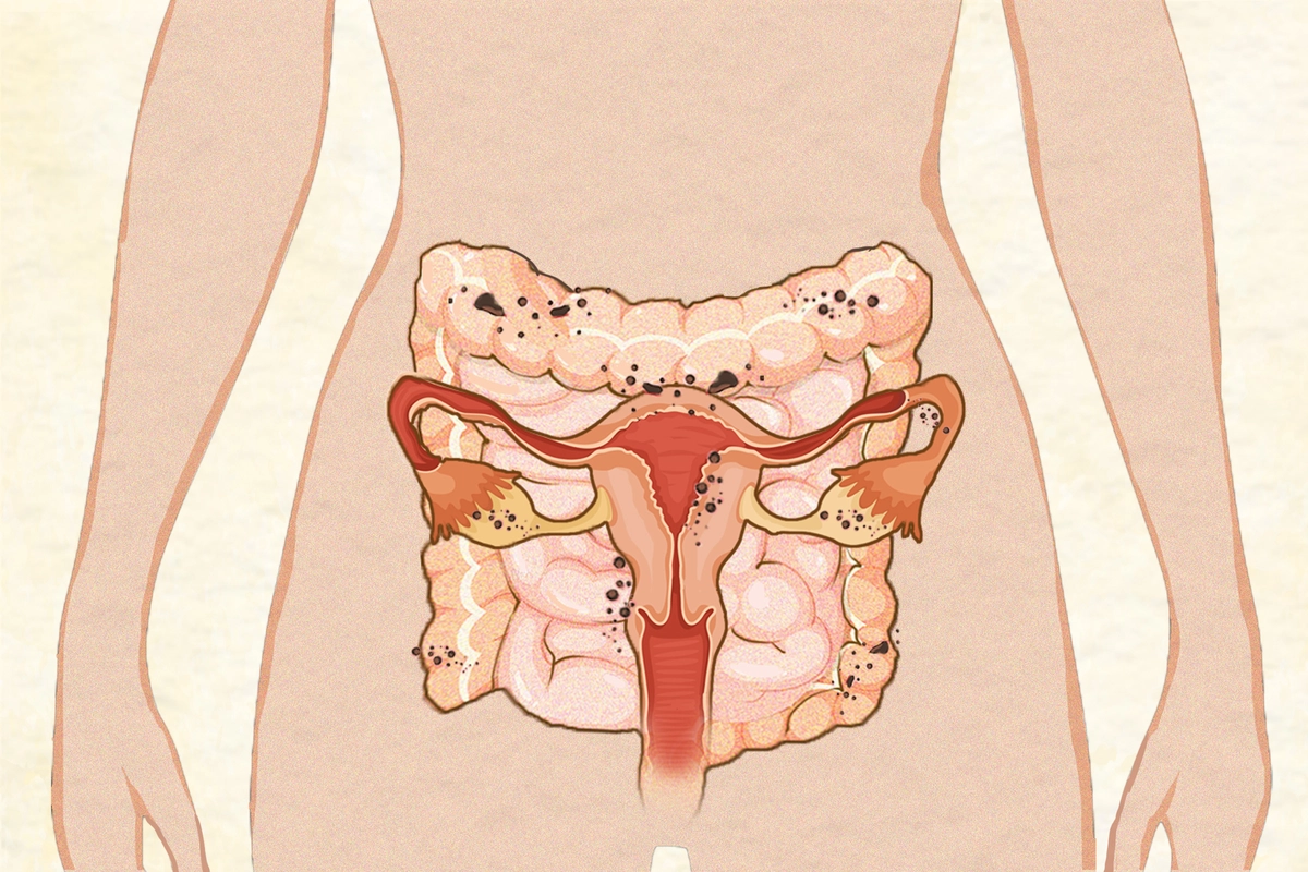 Endometriose